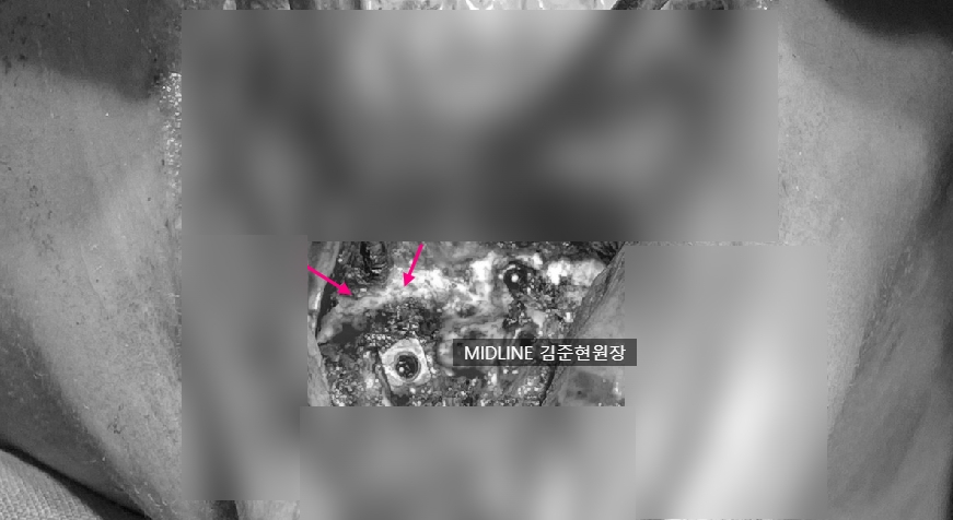윤곽 후 핀제거 수술 케이스, 꼭 필요한 것인가? 관련 이미지 8
