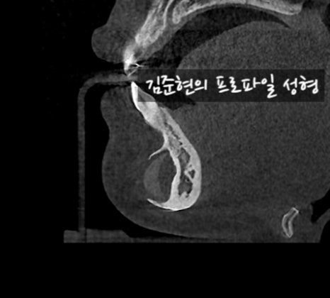 앞턱 보형물이 턱 옆으로 뚫고 나와요ㅠㅠ앞턱 보형물 제거 후 턱끝전진술을 한 케이스를 성형외과 전문의가 설명합니다. 관련 이미지 15
