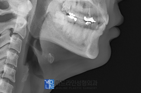 A Plastic Surgery Specialist Explains Why Chin Liposuction Is Sometimes Essential Because Jaw Reduction Surgery Alone Has Limited Effect image 10