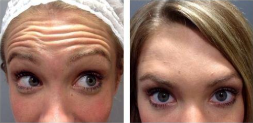 How Can Deep Forehead Wrinkles Be Resolved? (Feat. Forehead Lift + Filler) image 3