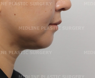 On the Effects of Advancement Genioplasty, Explained by a Board-Certified Plastic Surgeon. (feat. Rhinoplasty, Double Chin, Jawline Liposuction) image 10