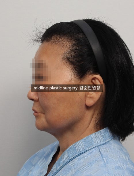 안면거상 흉터를 보여주는 곳은 없어서 미드라인성형외과가 보여드립니다. (feat. 심부볼리프팅) 관련 이미지 14