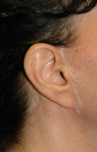 안면거상(Face lift, Rhytidectomy)에 대하여 성형외과 전문의가 알려드립니다. 관련 이미지 4