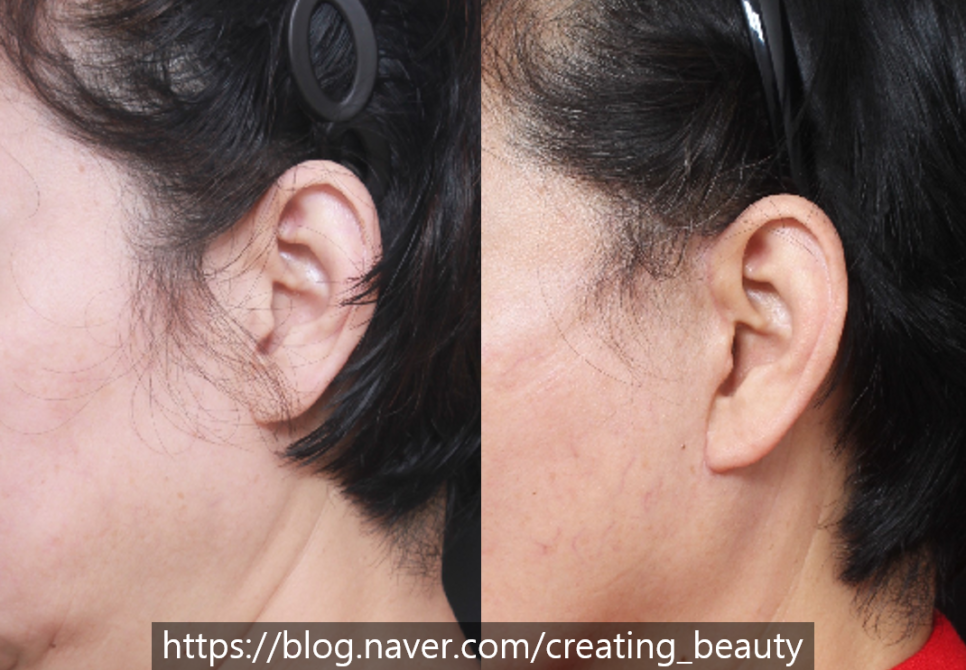 안면거상(Face lift, Rhytidectomy)에 대하여 성형외과 전문의가 알려드립니다. 관련 이미지 11