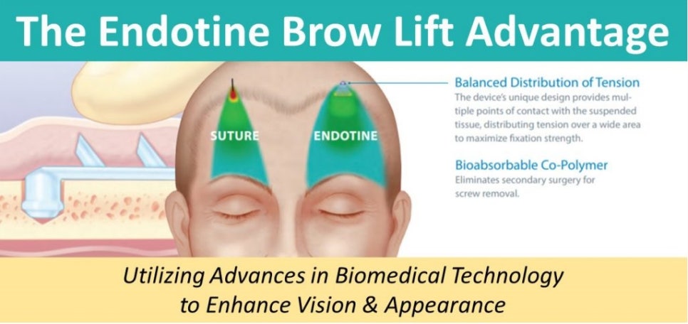Forehead Lift! Endotine vs Absorbable Thread — Explaining the Differences in Results and Side Effects image 8