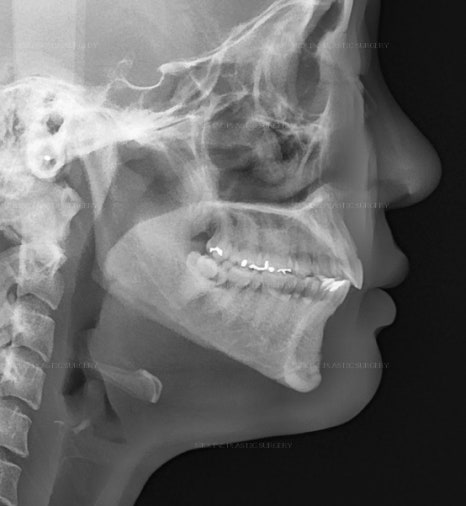 Fixing Sagging After Facial Contouring Surgery with a Face Lift!! (Feat. Plate Removal, Plate & Screw Removal) image 14