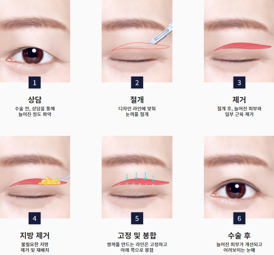 눈과 눈썹 사이가 가깝고 눈꺼풀이 처져 답답해보여요ㅠㅠ이마거상으로 해결가능합니다. (Feat. 눈밑지방재배치 + 지방이식) 관련 이미지 2