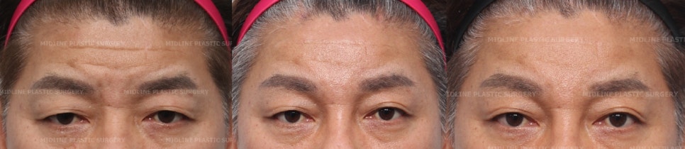 이마 주름이 너무 깊어졌어요ㅠㅠ.내시경 이마거상과 이마 주름 필러(Filler)로 어떻게 좋아지는지 성형외과 전문의가 설명드립니다. 관련 이미지 8
