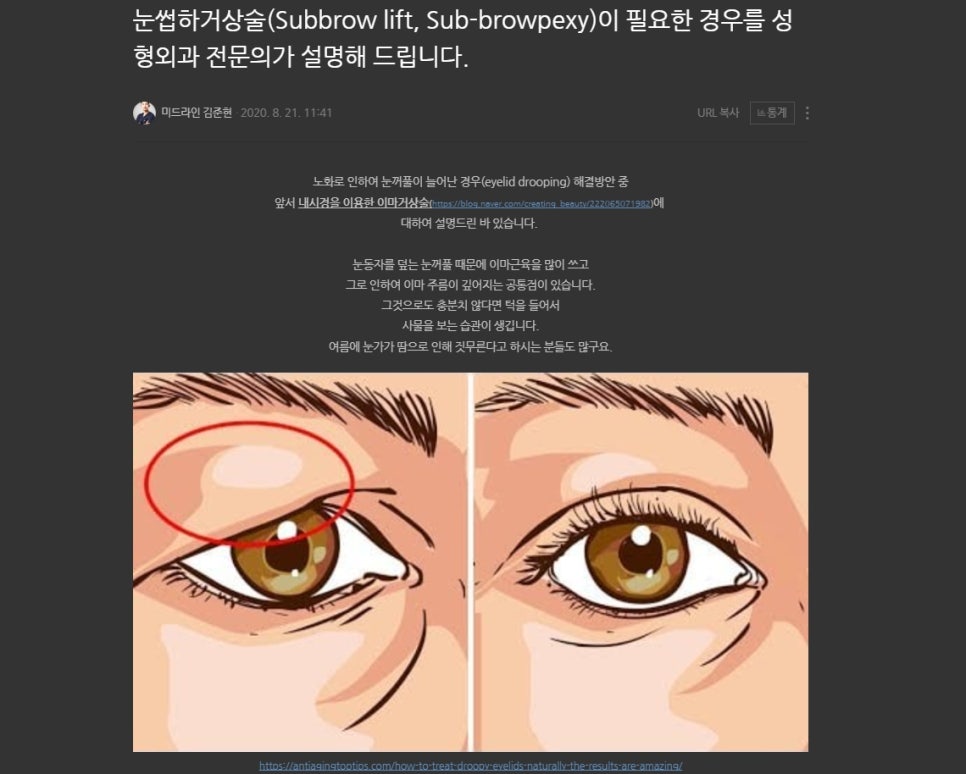 When Should Endoscopic Forehead Lift and Brow Lift Be Performed at the Same Time? (Feat. Lower Blepharoplasty) image 2