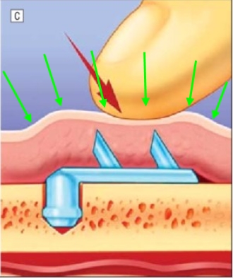 Forehead Lift! Endotine vs Absorbable Thread — Explaining the Differences in Results and Side Effects image 10