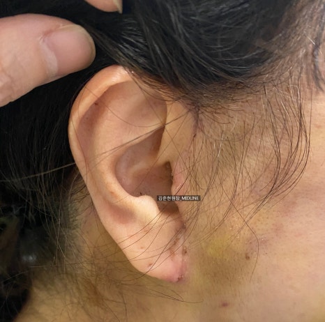얼굴 주름 리프팅, 오래 지속되고 효과 좋은 수술방법은? 관련 이미지 19