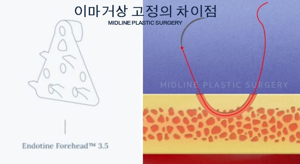 Forehead Lift! Endotine vs Absorbable Thread — Explaining the Differences in Results and Side Effects image 1