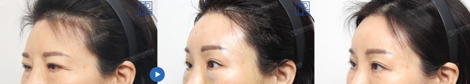 Endoscopic forehead lift that removes wrinkles and creates natural forehead volume! image 16