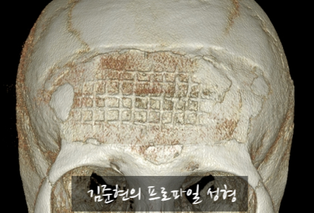I Removed Two Forehead Implants. A Board-Certified Plastic Surgeon Explains Why I Do Not Recommend Forehead Implants. image 7