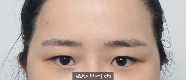 쌍꺼풀이 있는데 라인을 높이고  싶어요. 눈재수술을 하지 않고 라인 높이는 방법에 관하여 성형외과 전문의가 설명드립니다. (Feat. 내시경 이마거상, 뒤트임) 관련 이미지 1