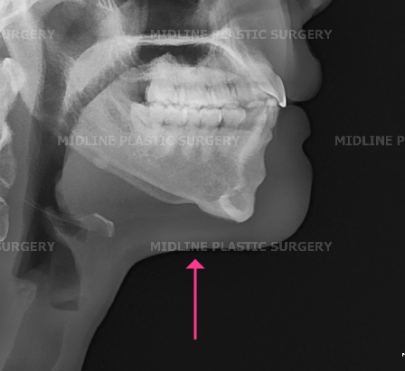 Fixing a Sagging Double Chin After Contouring Surgery! Let’s Learn About Mid-Up Lifting 2040. image 19