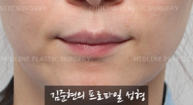 입술에 볼륨을 주는 방법은? 입술 지방이식에 관하여 관련 이미지 2