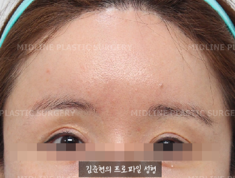 I want to go back to how it was before the forehead liftㅠ Is forehead lift reversal or release possible? image 1