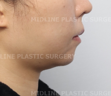 A Specialist Explains Chin Advancement Surgery After Removal of a Receded Chin Implant image 1