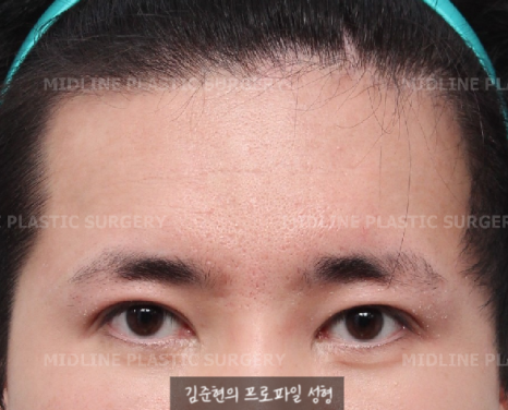 눈썹을 위로 올리는 습관으로 생긴 깊은 이마 주름이 고민이에요. 해결 방법은?(Feat. 이마거상 + 주름 필러) 관련 이미지 6