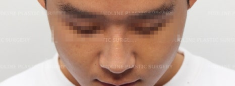 휜 코, 매부리 교정과 기능코-비중격만곡증까지 바로잡기 관련 이미지 25