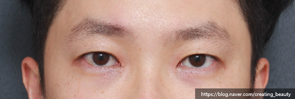 반드시 절개눈매교정으로 해야 하는 경우를 성형외과 전문의가 알려드립니다. 관련 이미지 3