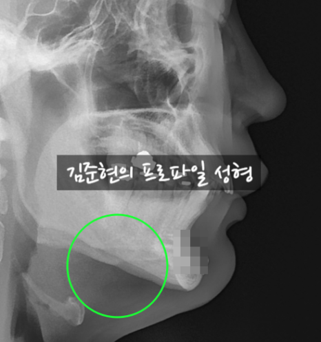 턱끝전진술로 생긴 이차각은 어떻게 되나요?! 관련 이미지 3