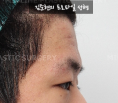 How Can Deep Forehead Wrinkles Be Resolved? (Feat. Forehead Lift + Filler) image 9