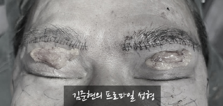 처지고 통통한(Puffy) 눈꺼풀 탈출하기!눈썹하거상(Subbrow lift)과 눈 위 지방제거(Feat. 하안검, 지방이식) 관련 이미지 7