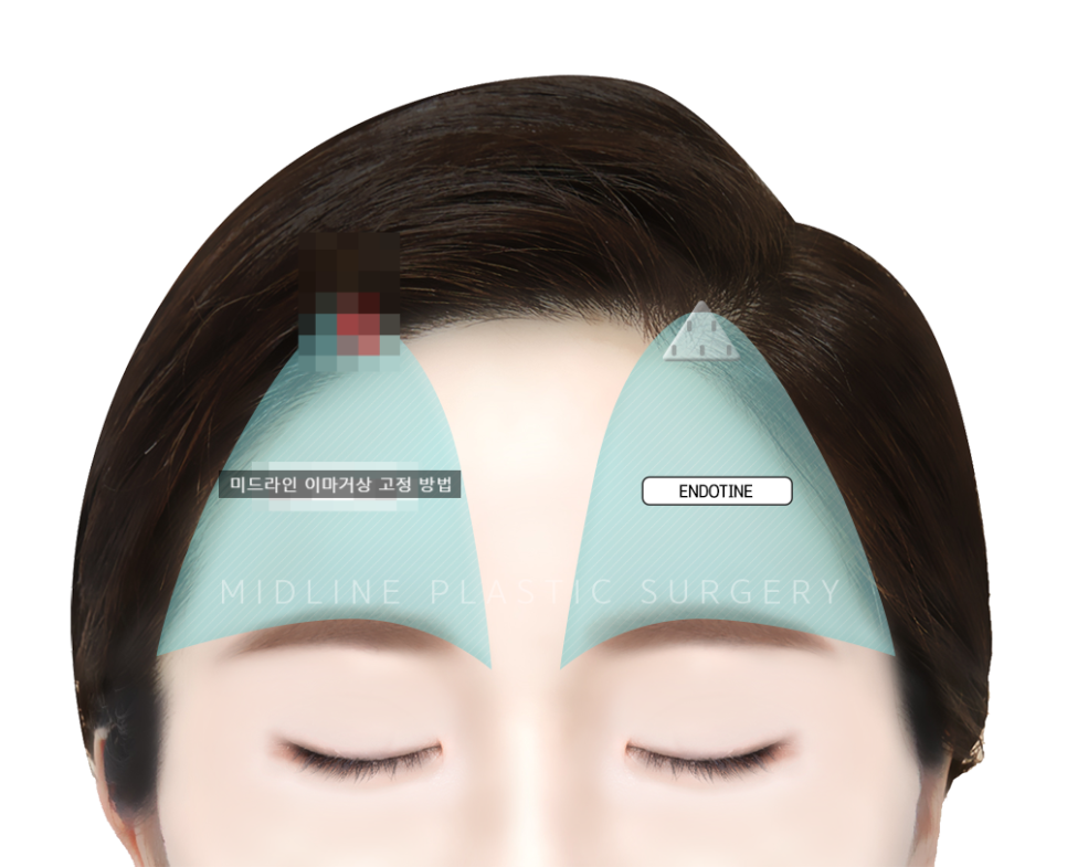Forehead Lift! Endotine vs Absorbable Thread — Explaining the Differences in Results and Side Effects image 9