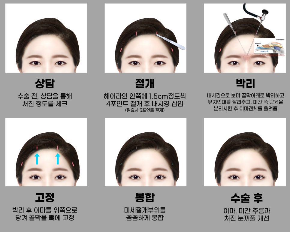 눈과 눈썹 사이가 가깝고 눈꺼풀이 처져 답답해보여요ㅠㅠ이마거상으로 해결가능합니다. (Feat. 눈밑지방재배치 + 지방이식) 관련 이미지 4