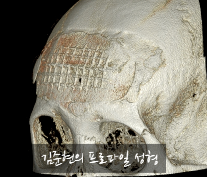 I Removed Two Forehead Implants. A Board-Certified Plastic Surgeon Explains Why I Do Not Recommend Forehead Implants. image 21