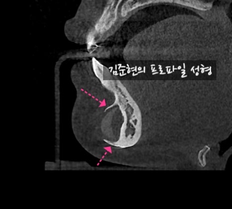 앞턱 보형물이 턱 옆으로 뚫고 나와요ㅠㅠ앞턱 보형물 제거 후 턱끝전진술을 한 케이스를 성형외과 전문의가 설명합니다. 관련 이미지 8