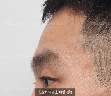 쌍꺼풀을 하려는데 이마주름이 심각해요....어떡하죠? 상남자의 자연스런 쌍꺼풀 만들기(Feat. 내시경 이마거상) 관련 이미지 10