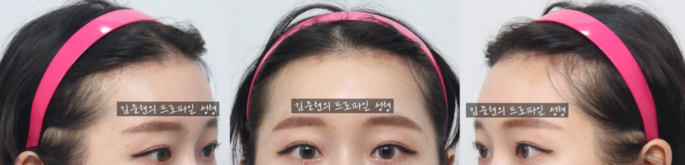 My Double Eyelids Are Hidden and I Want a Forehead Lift, But My Forehead Is Also Wide. What Should I Do? A Plastic Surgery Specialist Explains. (Forehead Lift + Forehead Reduction at the Same Time!) image 4
