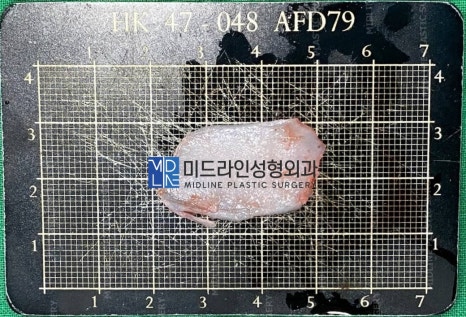 코막힘 원인, 비밸브재건술에 대하여 성형외과 전문의가 설명드립니다. 관련 이미지 6