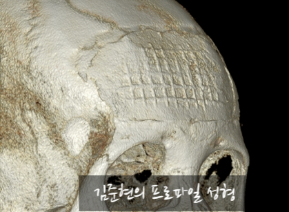 I Removed Two Forehead Implants. A Board-Certified Plastic Surgeon Explains Why I Do Not Recommend Forehead Implants. image 20