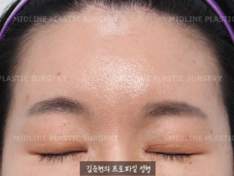 Because of the Mongolian fold, the eyes look cramped — epicanthoplasty can fix it. (Feat. Endoscopic forehead lift) image 9