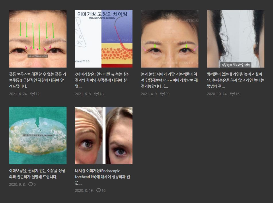 Endoscopic forehead lift that removes wrinkles and creates natural forehead volume! image 4