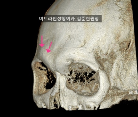 눈썹뼈 절삭에 관하여 (안와상융기) 관련 이미지 20