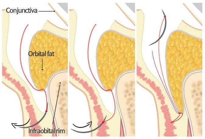 성형외과 전문의가 눈밑수술 케이스의 진단방법 및 나이들면 하는 수술이다라는 오해에 대해 설명해드립니다. 관련 이미지 12