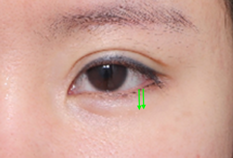 What Type of Plastic Surgery Is Needed for Small, Cramped Eyes? (About Lateral, Lower, and Combined Lateral-Lower Canthoplasty) image 5