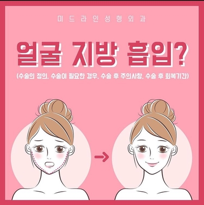 이중턱 지방흡입의 효과에 대하여 전문의가 알려드립니다. 관련 이미지 2