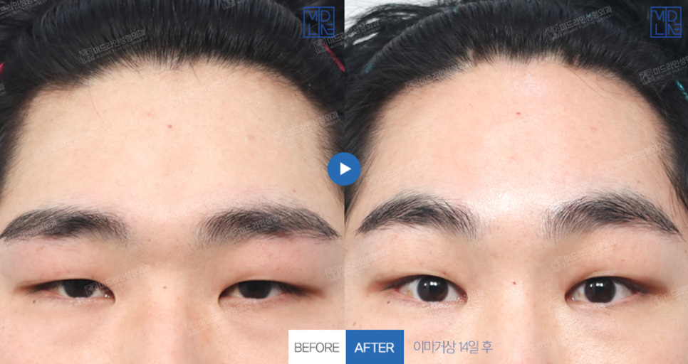 <1편> 쌍꺼풀 수술 없이 눈을 크게 만드는 방법을 성형외과 전문의가 직접 설명드립니다. 관련 이미지 1