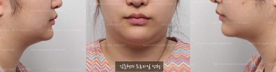 이중턱이 고민이에요ㅠㅠ숨은 턱선을 찾아주는 이중턱, 턱라인 지방흡입! 미드업 2040에 관하여 설명드립니다. 관련 이미지 4