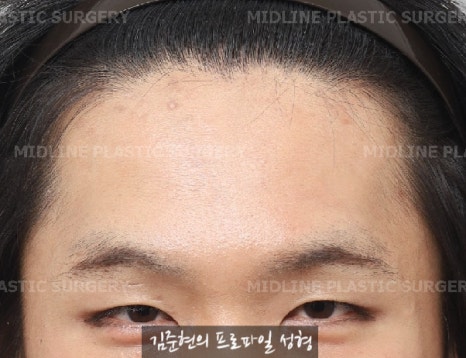 눈썹뼈절삭, 어떨 때 어떻게 하는 수술일까요? 꼭 이마거상과 함께 해야만 하는 수술인가요? 미드라인성형외과에서 하는 눈썹뼈절삭 수술을 설명드립니다. (3D CT 있음) 관련 이미지 14