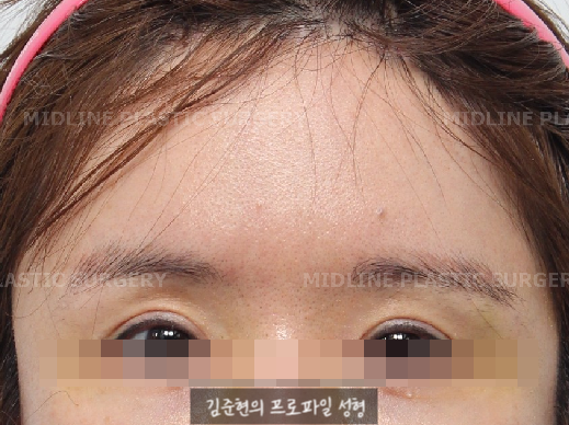 I want to go back to how it was before the forehead liftㅠ Is forehead lift reversal or release possible? image 2
