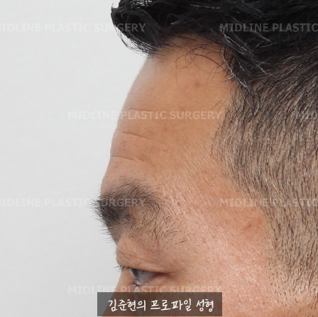 쌍꺼풀을 하려는데 이마주름이 심각해요....어떡하죠? 상남자의 자연스런 쌍꺼풀 만들기(Feat. 내시경 이마거상) 관련 이미지 5