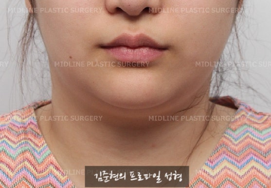 이중턱이 고민이에요ㅠㅠ숨은 턱선을 찾아주는 이중턱, 턱라인 지방흡입! 미드업 2040에 관하여 설명드립니다. 관련 이미지 1