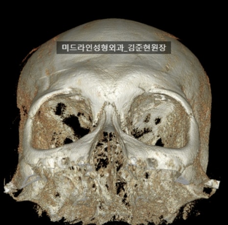 눈썹뼈 절삭에 관하여 (안와상융기) 관련 이미지 3